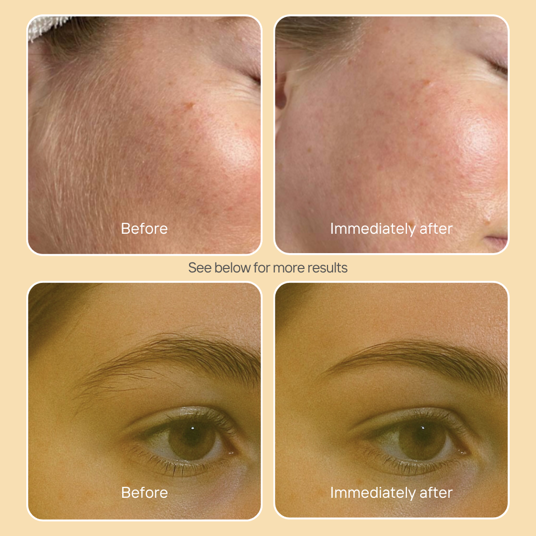 Mini Derma Pro